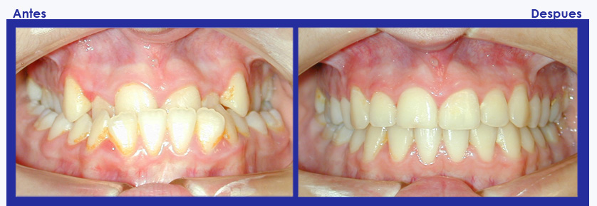 Resultados de ortodoncia