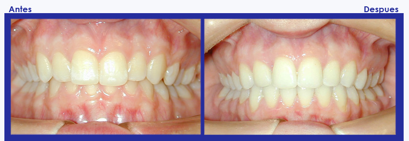 Resultados de ortodoncia
